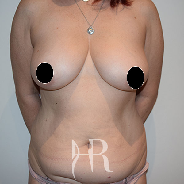 HR Plastic Surgery - Tummy Tuck patient before 22