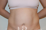HR Plastic Surgery - Tummy Tuck patient before 23