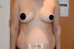 HR Plastic Surgery - Tummy Tuck patient before 26