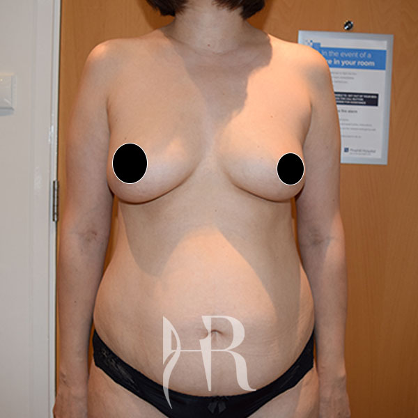 HR Plastic Surgery - Tummy Tuck patient before 26