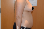HR Plastic Surgery - Tummy Tuck patient before 28