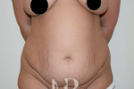 HR Plastic Surgery - Tummy Tuck patient before 6