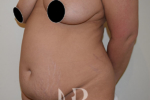 HR Plastic Surgery - Tummy Tuck patient before 7