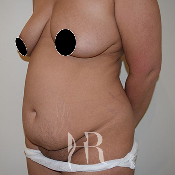 HR Plastic Surgery - Tummy Tuck patient before 7