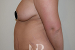 HR Plastic Surgery - Tummy Tuck patient before 8