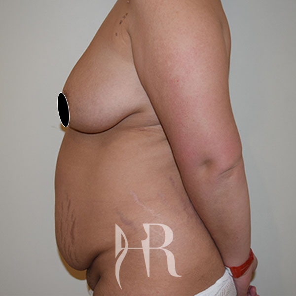 HR Plastic Surgery - Tummy Tuck patient before 8