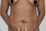 HR Plastic Surgery - Tummy Tuck patient before 9