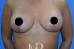 HR Plastic Surgery - Breast Enlargement With Uplift patient after 4