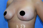 HR Plastic Surgery - Breast Enlargement With Uplift patient after 5