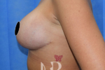HR Plastic Surgery - Breast Enlargement With Uplift patient after 6