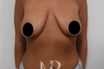 HR Plastic Surgery - Breast Enlargement With Uplift patient before 4