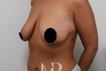 HR Plastic Surgery - Breast Enlargement With Uplift patient before 5