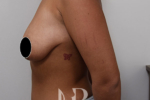 HR Plastic Surgery - Breast Enlargement With Uplift patient before 6