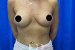 HR Plastic Surgery - augmentation mastopexy patient after 1