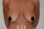 HR Plastic Surgery - augmentation mastopexy patient before 1