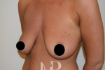 HR Plastic Surgery - Breast Enlargement With Uplift patient before 2