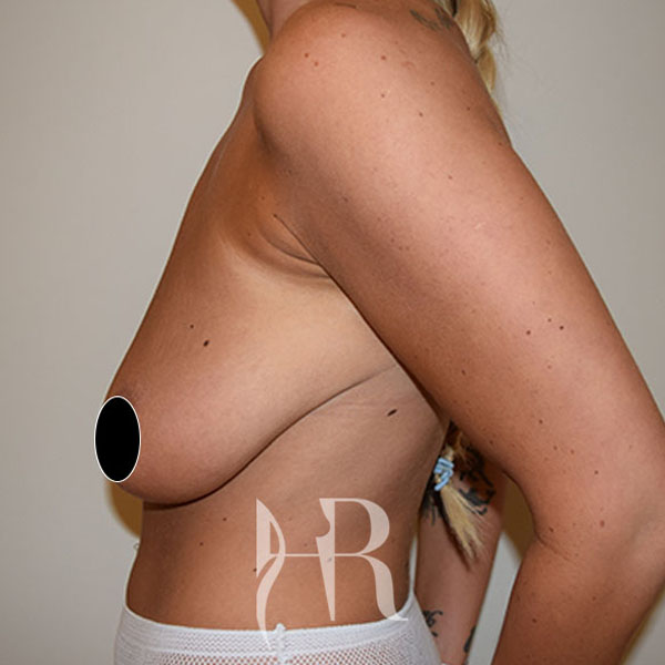 HR Plastic Surgery - Breast Enlargement With Uplift patient before 3
