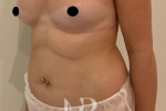 HR Plastic Surgery - Breast Enlargement patient before 14