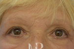 HR Plastic Surgery - Eyelid Surgery (Blepharoplasty) patient after 1