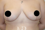 HR Plastic Surgery - Breast Asymmetry patient after 1