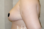 HR Plastic Surgery - Breast Asymmetry patient after 2