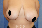 HR Plastic Surgery - Breast Asymmetry patient before 1