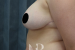 HR Plastic Surgery - Breast Reduction patient after 6