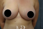 HR Plastic Surgery - Breast Reduction patient after 8