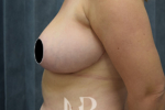 HR Plastic Surgery - Breast Reduction patient after 10