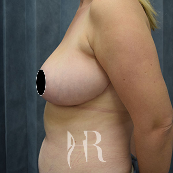 HR Plastic Surgery - Breast Reduction patient after 10