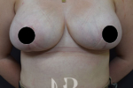 HR Plastic Surgery - Breast Reduction patient after 11