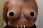 HR Plastic Surgery - Breast Reduction patient after 13