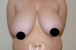 HR Plastic Surgery - Breast Reduction patient before 4