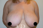 HR Plastic Surgery - Breast Reduction patient before 7