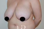 HR Plastic Surgery - Breast Reduction patient before 5
