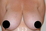 HR Plastic Surgery - Breast Reduction patient before 8