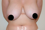 HR Plastic Surgery - Breast Reduction patient before 11