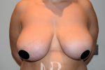 HR Plastic Surgery - Breast Reduction patient before 13
