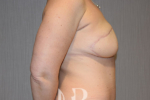 HR Plastic Surgery - Breast Reconstruction patient after 5