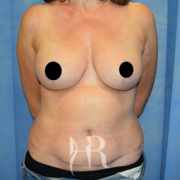 HR Plastic Surgery - Breast Reconstruction patient after 4