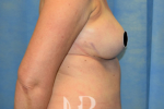 HR Plastic Surgery - Breast Reconstruction patient after 2