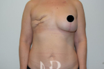 HR Plastic Surgery - Breast Reconstruction patient before 7