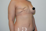 HR Plastic Surgery - Breast Reconstruction patient before 6