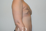 HR Plastic Surgery - Breast Reconstruction patient before 5