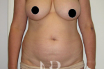 HR Plastic Surgery - Breast Reconstruction patient before 4