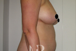 HR Plastic Surgery - Breast Reconstruction patient before 2