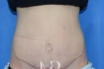 HR Plastic Surgery - Diastasis Recti Surgery patient after 1