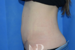 HR Plastic Surgery - Diastasis Recti Surgery patient after 2