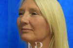 after a facelift picture