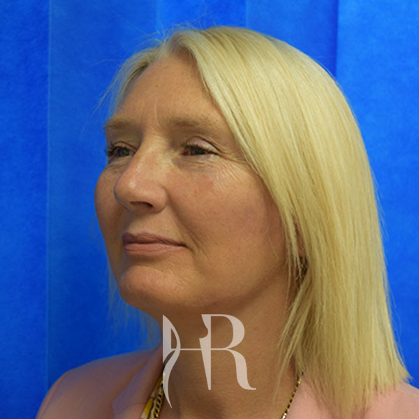 after a facelift picture
